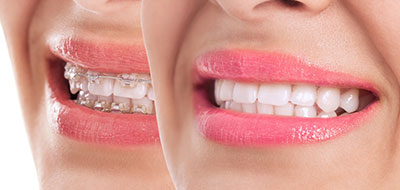Riverdale Dental Arts | Dental Sealants, Sports Mouthguards and Root Canals