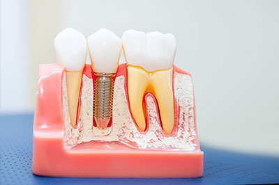Riverdale Dental Arts | Sports Mouthguards, Emergency Treatment and Teeth Whitening