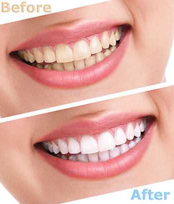 Riverdale Dental Arts | Dentures, Teeth Whitening and Oral Exams